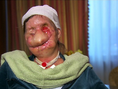 Charla Nash's face after the chimp attack