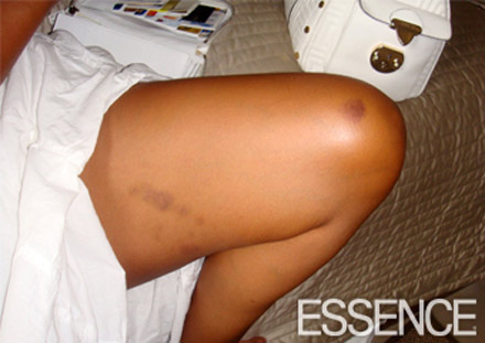  LisaRaye McCoy's injuries - the thigh