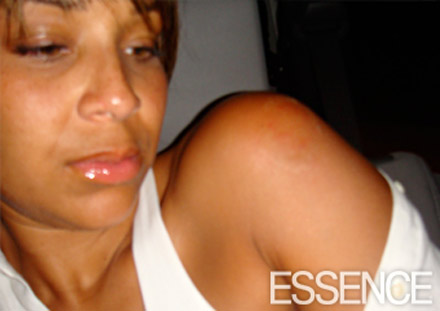  LisaRaye McCoy's injuries - the shoulder