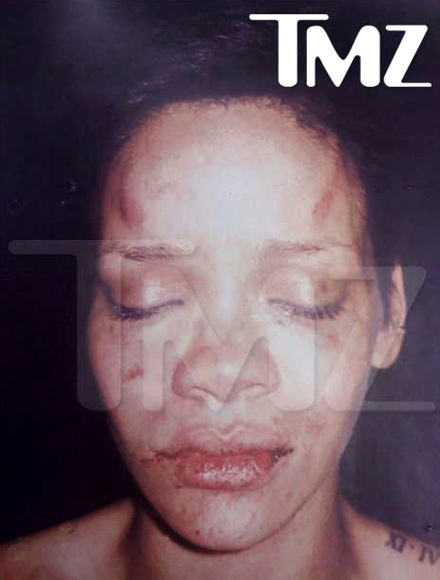 Rihanna / Chris Brown fight photo - the bumps and bruises