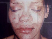 Rihanna / Chris Brown fight photo - the bumps and bruises